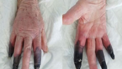 صورة “أعراض غريبة لكورونا”.. بتر أصابع امرأة إيطالية بعد إصابتها بالفيروس