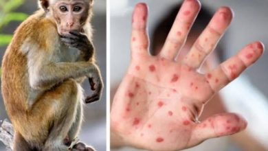 صورة فرنسا تعلن عن تسجيل إصابات جديدة بجدري القردة