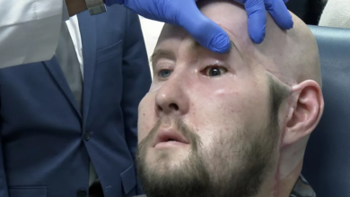 صورة إجراء أول عملية زراعة عين كاملة في العالم