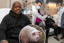 صورة بعد شهرين من العملية.. وفاة أول مريض يخضع لزراعة كلية خنزير معدلة وراثيا